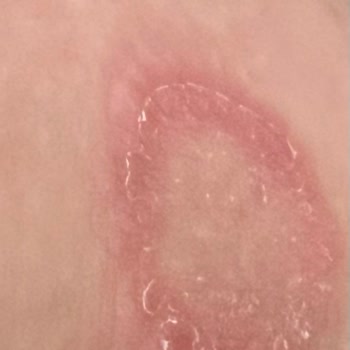 İdaş Club Hotel Havuz Hijyeni Ve Sağlık Sorunları Nedeniyle Yaşanan Mağduriyet!