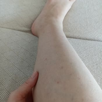 Ağda Bandı Cildimde Alerji Ve Kaşıntıya Sebep Oldu