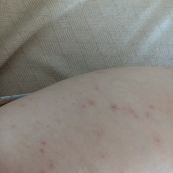 Ağda Bandı Cildimde Alerji Ve Kaşıntıya Sebep Oldu