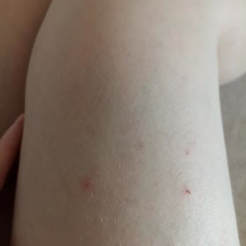 Ağda Bandı Cildimde Alerji Ve Kaşıntıya Sebep Oldu