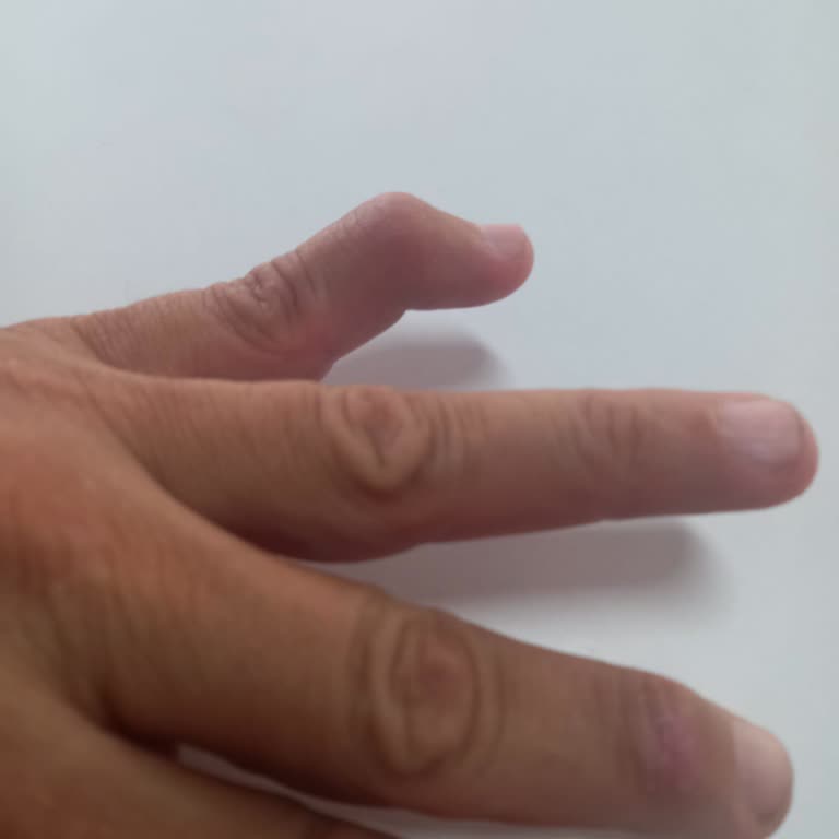 Belediyenin İhmali Yüzünden Kaza Geçirdim, İlgisizlikle Karşılaştım