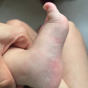 Bebek Ayakkabısı Ayağa Zarar Verdi, İade Talebim Reddedildi