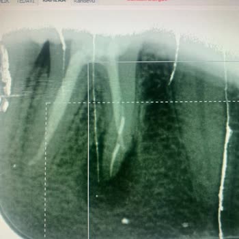 Kanal Tedavisinde Gizlenen Kırık Alet Mağduriyeti