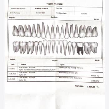 Kanal Tedavisinde Gizlenen Kırık Alet Mağduriyeti
