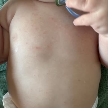 Mustela Ürünleri Bebeğimde Şiddetli Alerjiye Sebep Oldu