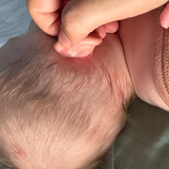 Mustela Ürünleri Bebeğimde Şiddetli Alerjiye Sebep Oldu