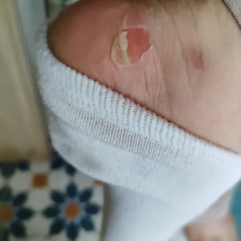 Ayakkabı Kullanımında Yaşanan Sorun ve İade Talebi