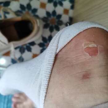 Ayakkabı Kullanımında Yaşanan Sorun ve İade Talebi