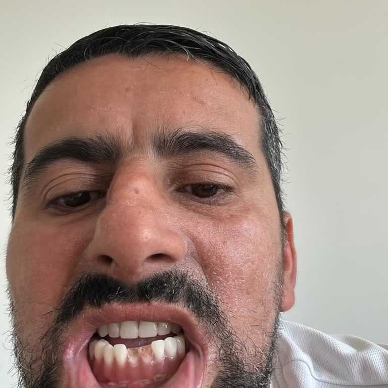 Avrupadent Avcılar Lusso Geçici Protezlerim Düştü Kimse Yardımcı Olmadı