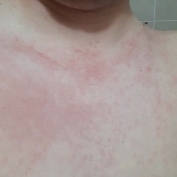 Hassas Ciltler İçin Satılan Ürün Cildimi Tahriş Etti, Mağduriyetimin Giderilmesini İstiyorum