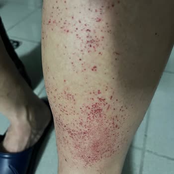 Ciltte Şiddetli Tahriş Ve Hayal Kırıklığı