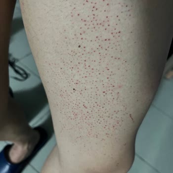 Ciltte Şiddetli Tahriş Ve Hayal Kırıklığı