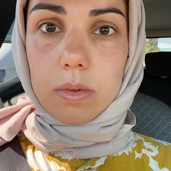 Yves Rocher Güneş Kremi Yüzümde Alerji Ve Ödem Yaptı Bilgilendirme Eksikti