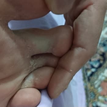 Collajen Kullanımında Ciddi Kaşıntı Ve Döküntü Sorunu