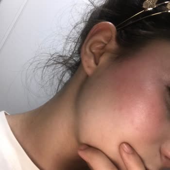 Yüz Temizleme Jeli Sonrası Cildimde Beklenmedik Lekeler Oluştu