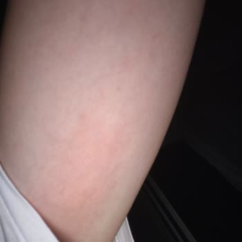 Raid Sivrisinek Kovucu Etkisiz Kaldı, Mağdur Olduk