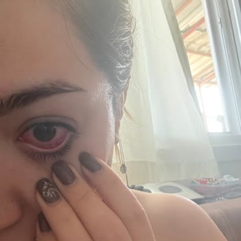 Aldığım Göz Serumu Ciddi Sağlık Sorunlarına Yol Açtı, Mağduriyetimin Giderilmesini Talep Ediyorum