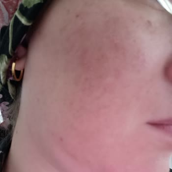 Bee Beauty Yüz Güneş Kremi Alerji Ve Sivilce Yaptı Pişmanlık Yaşadım