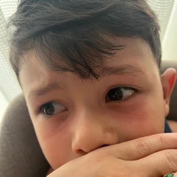 Nivea Çocuk Güneş Kremi Ciltte Kızarıklık Ve Koruma Eksikliği Yaşattı