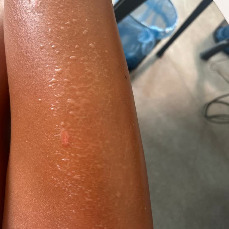 Trendyol Lancaster Güneş Kremi Alerji Yaptı!