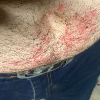 Yanlış Uygulama Sonucu Oluşan Yaralar Ve İlgisiz Hizmet Deneyimi