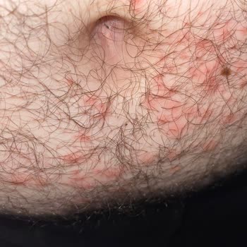 Yanlış Uygulama Sonucu Oluşan Yaralar Ve İlgisiz Hizmet Deneyimi