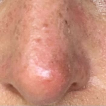 Selin Özbey Bronzlaştırıcı Yağ Kullanımı Sonrası Cilt Sorunu ve Tatil Hayal Kırıklığı