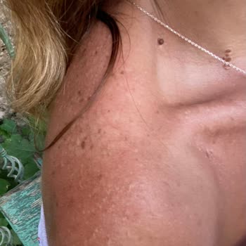 Selin Özbey Bronzlaştırıcı Yağ Kullanımı Sonrası Cilt Sorunu ve Tatil Hayal Kırıklığı