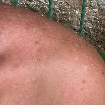 Selin Özbey Bronzlaştırıcı Yağ Kullanımı Sonrası Cilt Sorunu ve Tatil Hayal Kırıklığı