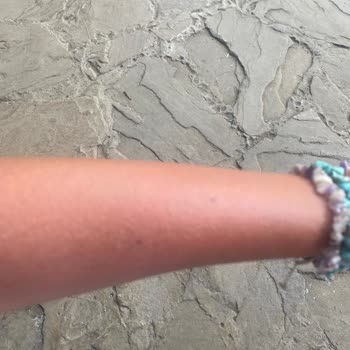 Selin Özbey Bronzlaştırıcı Yağ Kullanımı Sonrası Cilt Sorunu ve Tatil Hayal Kırıklığı