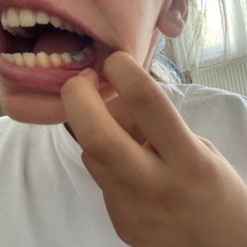 Devlette Yapılan Kanal Tedavisinde Dişim Simsiyah Kaldı