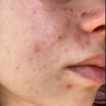 Ciddi Cilt Sorunlarım Varken Sigortam Muayenemi Kozmetik Diyerek Reddetti