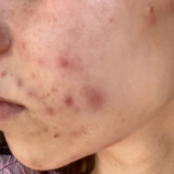 Ciddi Cilt Sorunlarım Varken Sigortam Muayenemi Kozmetik Diyerek Reddetti