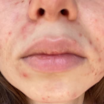 Ciddi Cilt Sorunlarım Varken Sigortam Muayenemi Kozmetik Diyerek Reddetti