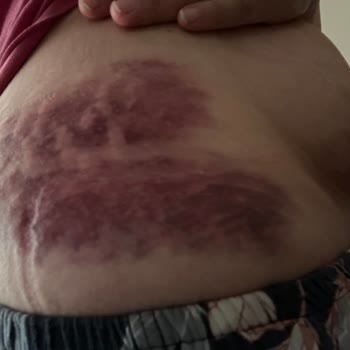 Sua Beauty Kendi Hataları Yüzünden Her Yerim Şişti Morardı