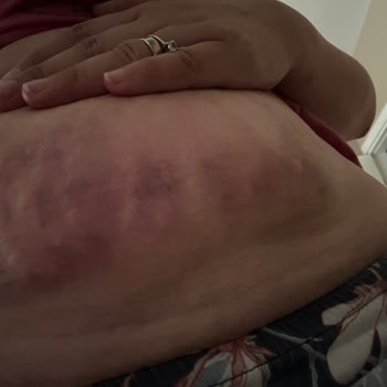 Sua Beauty Kendi Hataları Yüzünden Her Yerim Şişti Morardı