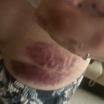 Sua Beauty Kendi Hataları Yüzünden Her Yerim Şişti Morardı