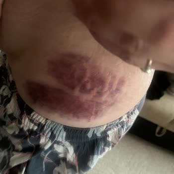 Sua Beauty Kendi Hataları Yüzünden Her Yerim Şişti Morardı