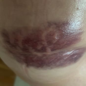 Sua Beauty Kendi Hataları Yüzünden Her Yerim Şişti Morardı