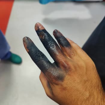 Volta Se 03 Model Motorun Aküsü Elimde Patladı