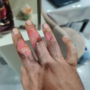 Volta Se 03 Model Motorun Aküsü Elimde Patladı