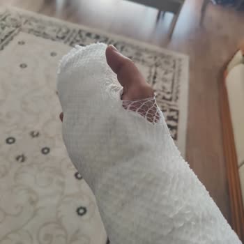 Volta Se 03 Model Motorun Aküsü Elimde Patladı