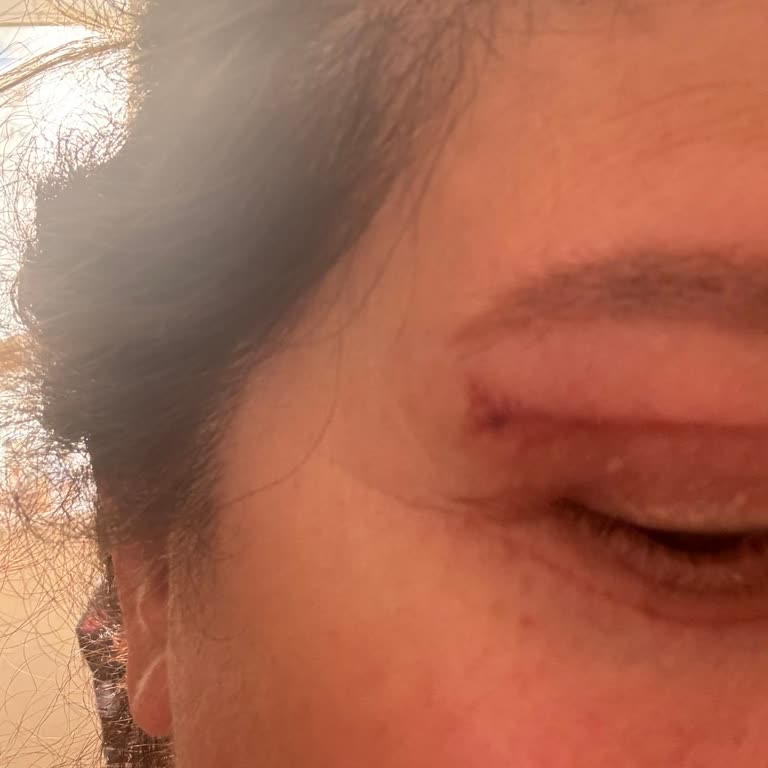 Assos İlaç Contractubex Jel Aşırı Derecede Kaşıntı Ve Kızarıklık Yaptı