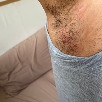 Koltuk Altında Ağrılı Şişlik Ve Cilt Sorunu Yaşadım