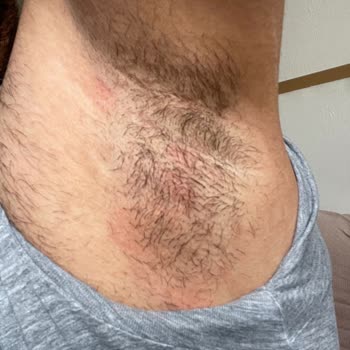 Koltuk Altında Ağrılı Şişlik Ve Cilt Sorunu Yaşadım