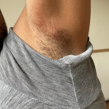 Koltuk Altında Ağrılı Şişlik Ve Cilt Sorunu Yaşadım