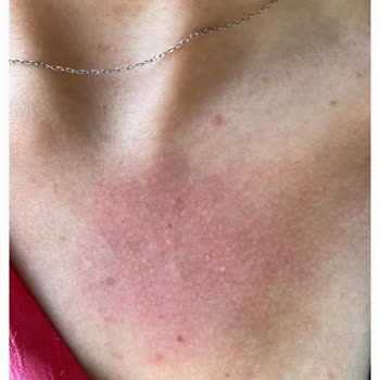 Alerji Yapan Parfüm İçin İade Süreci Mağduriyeti Ve Bilgilendirme Eksikliği