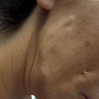 Dr. Diva Estetik Ve Güzellik Yüzünden Dolgu Sonrası Yüzüm Mahvoldu