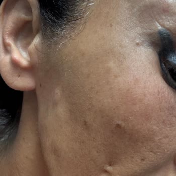 Dr. Diva Estetik Ve Güzellik Yüzünden Dolgu Sonrası Yüzüm Mahvoldu