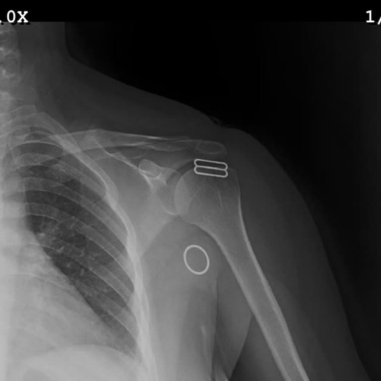 Yanlış Teşhis Ve İhmal: Kırıklar Görülmedi, Mağdur Edildim